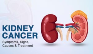 kidney Cancer Treatments in Bangalore | World of Urology