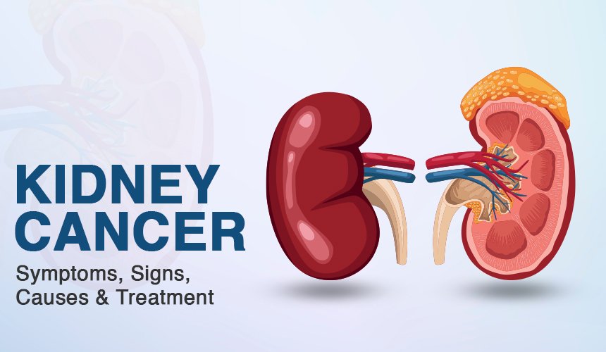 kidney Cancer Treatments in Bangalore | World of Urology